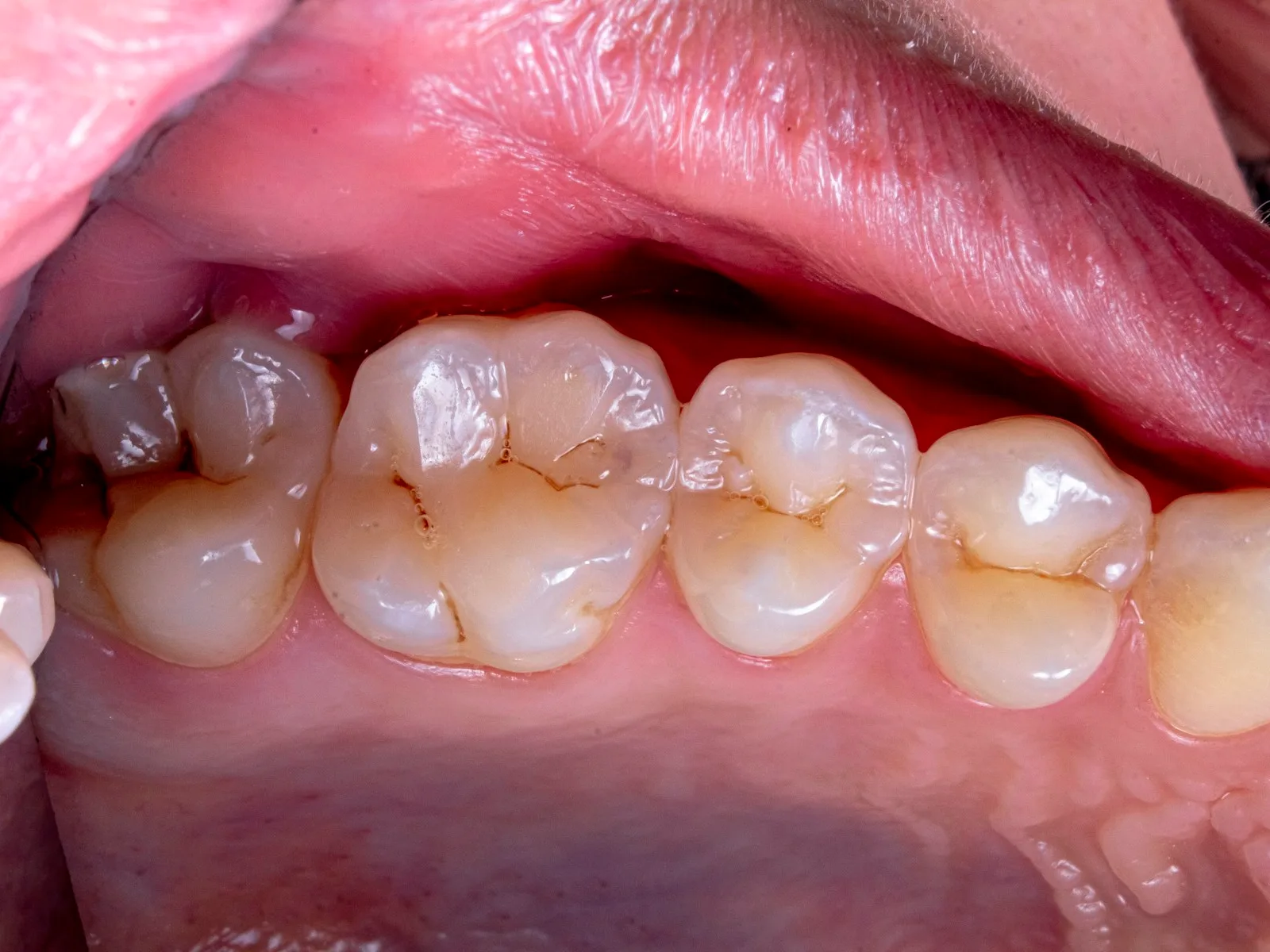 Close dos dentes posteriores com desgaste e fissuras no esmalte