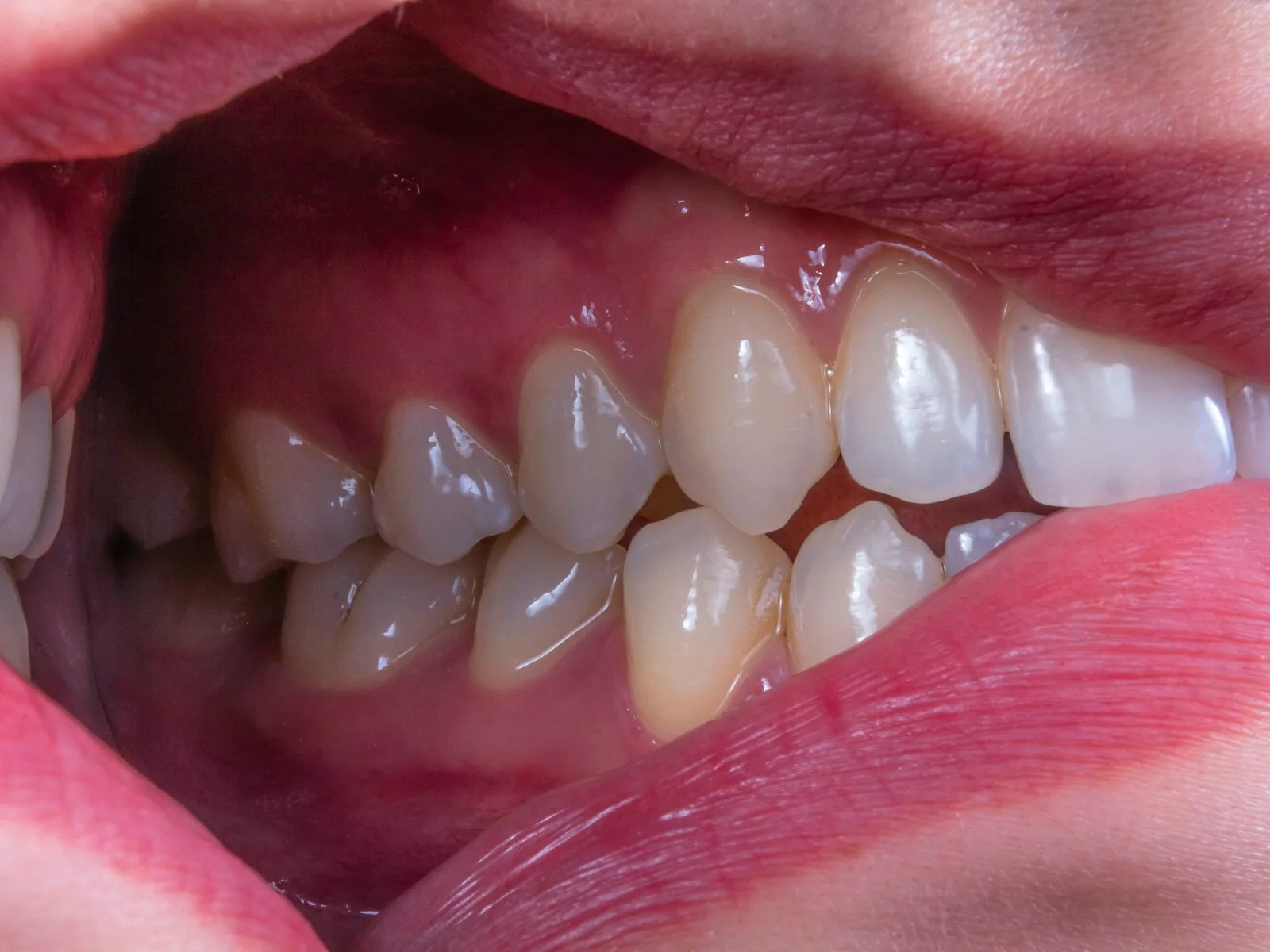 Close dos dentes apinhados e desalinhados