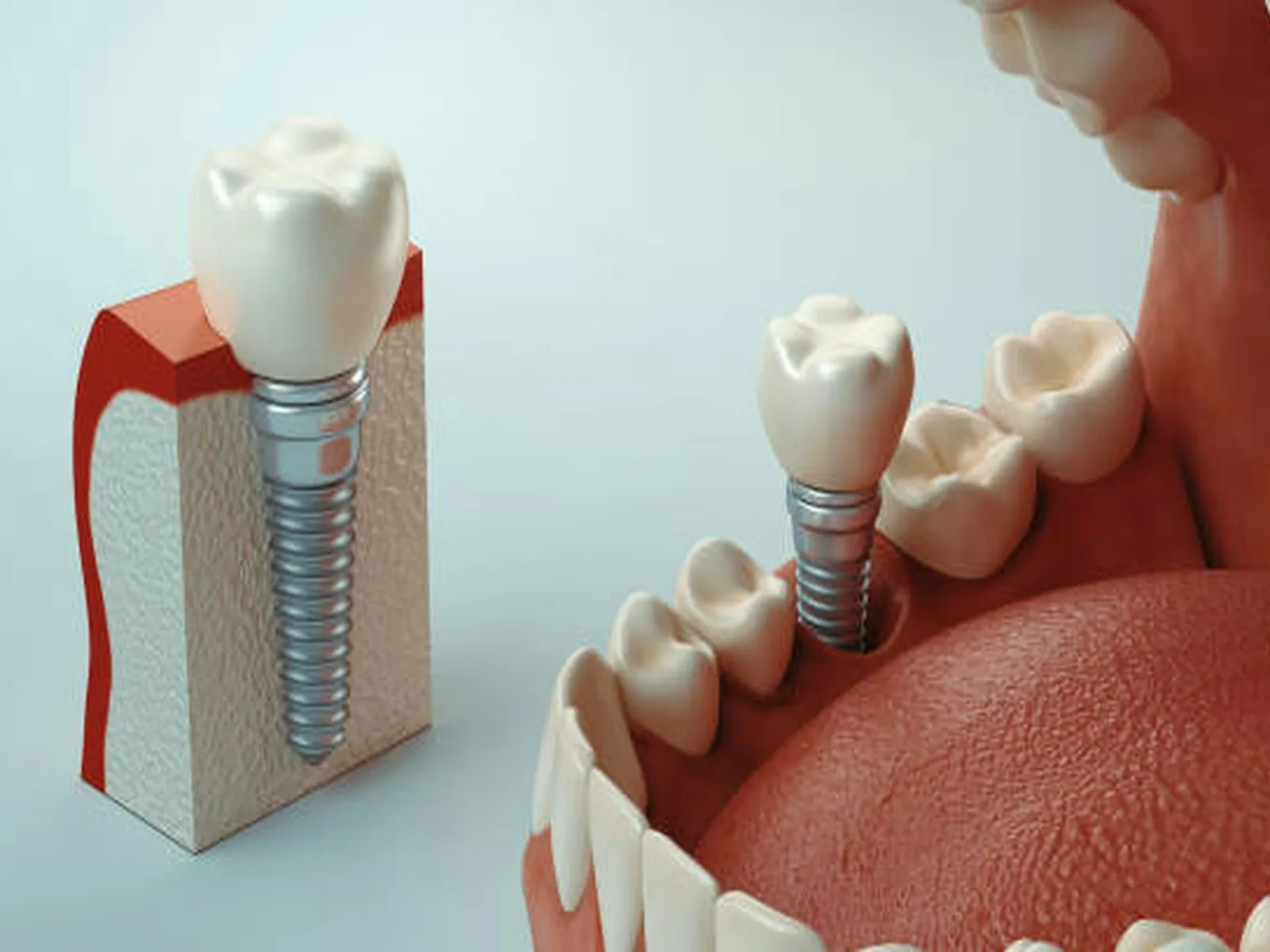 Modelo de arcada com um dente ausente e um implante ao lado