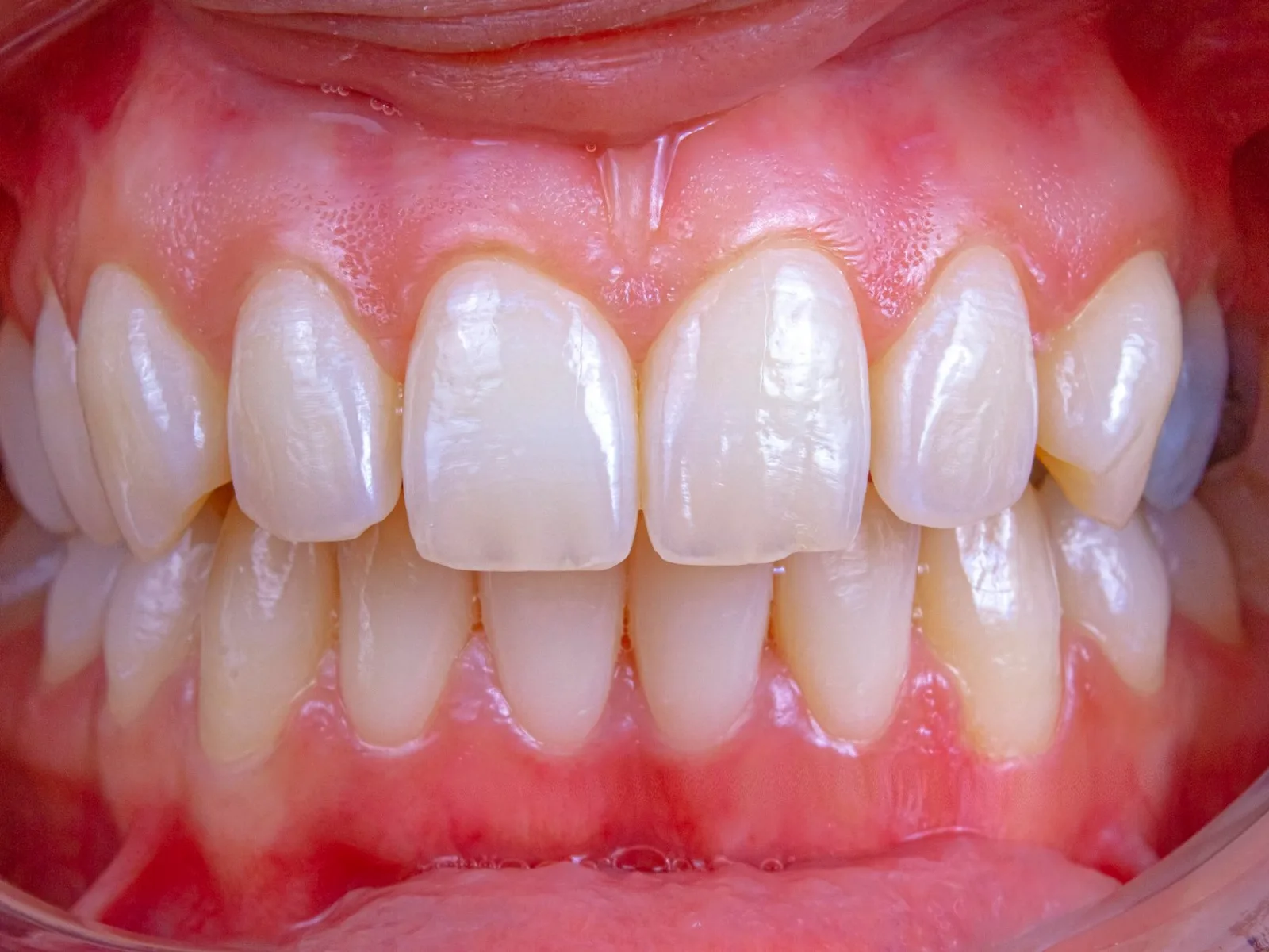 Close dos dentes com a gengiva avermelhada