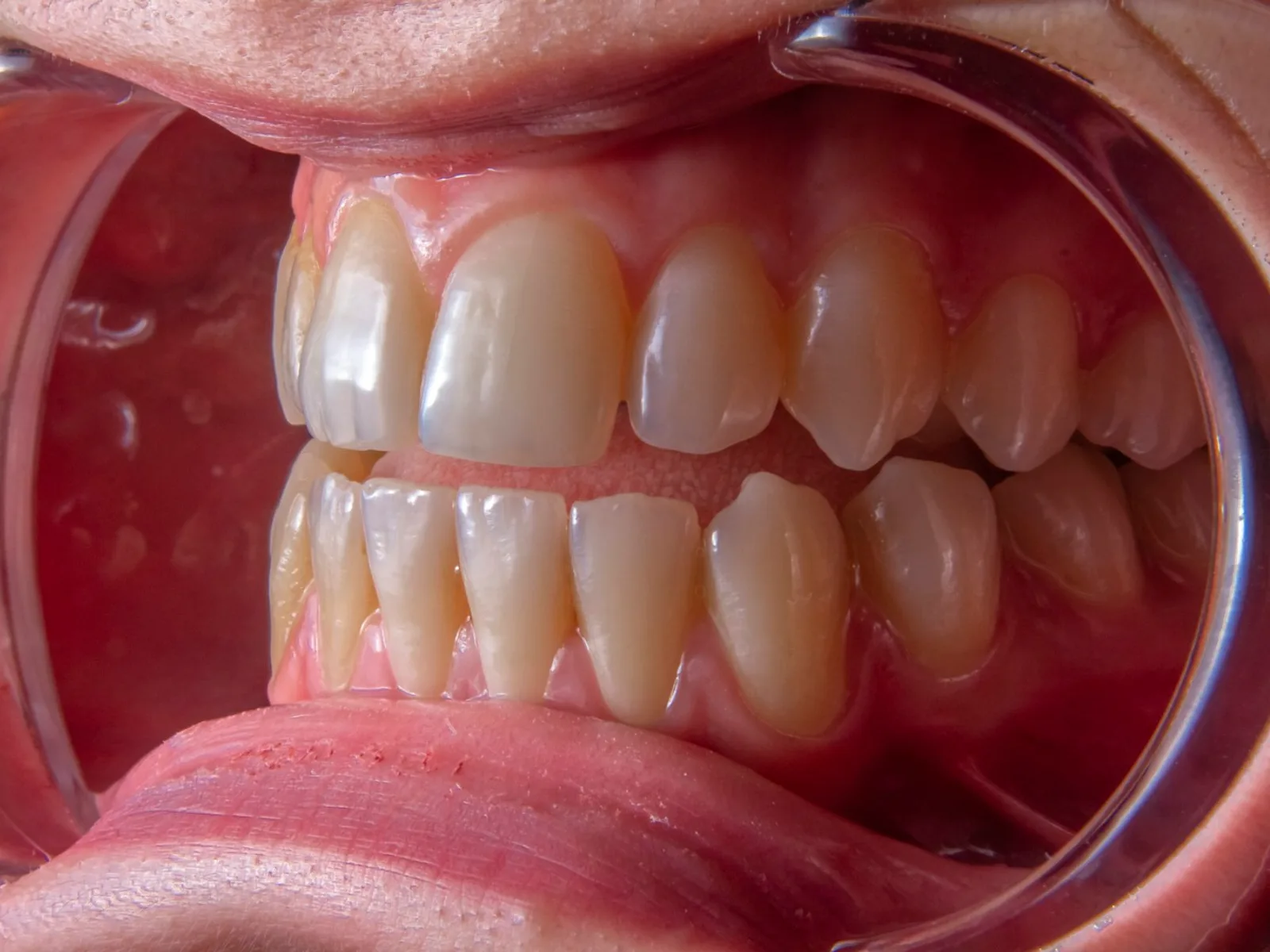 Close dos dentes com tom amarelado