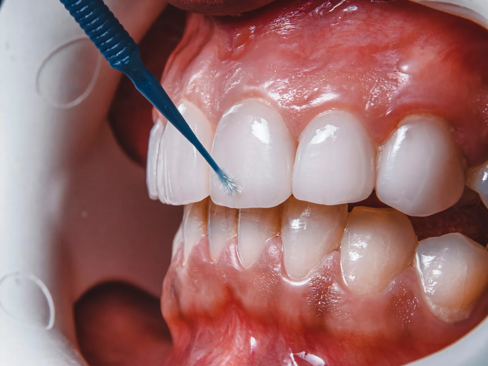 Close da região dos dentes e da gengiva sendo avaliada com uma sonda